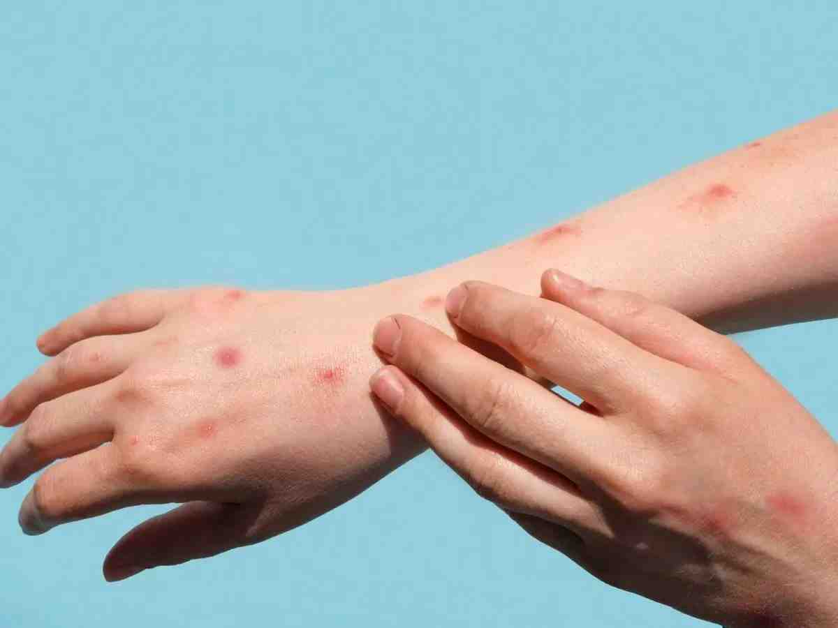 Does BCG vaccine last for life?