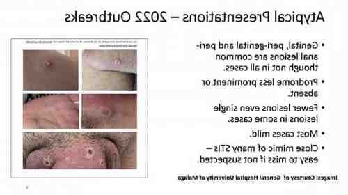 The monkeypox treatment