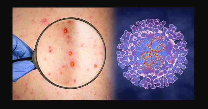 How do I get rid of monkeypox?